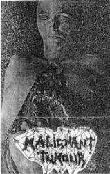 Malignant Tumour : Crush Syndrome - Surgical Problems